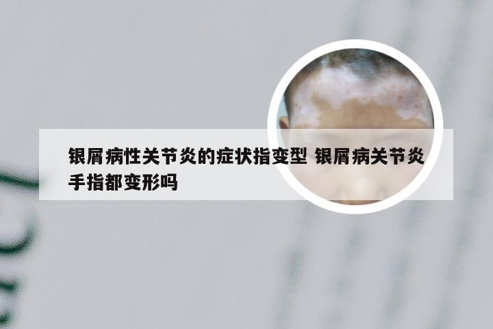 银屑病性关节炎的症状指变型 银屑病关节炎手指都变形吗