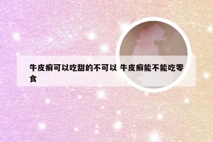 牛皮癣可以吃甜的不可以 牛皮癣能不能吃零食