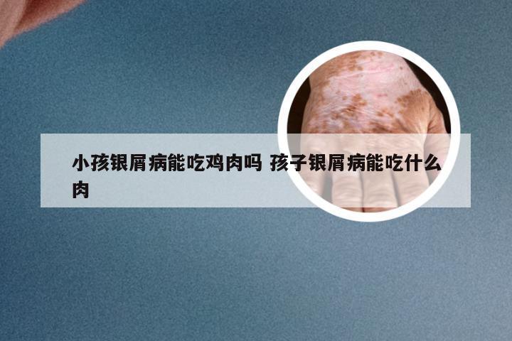 小孩银屑病能吃鸡肉吗 孩子银屑病能吃什么肉