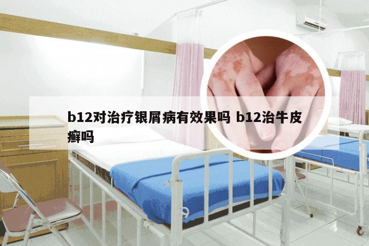 b12对治疗银屑病有效果吗 b12治牛皮癣吗