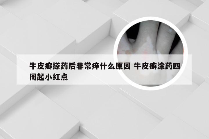 牛皮癣搽药后非常痒什么原因 牛皮癣涂药四周起小红点