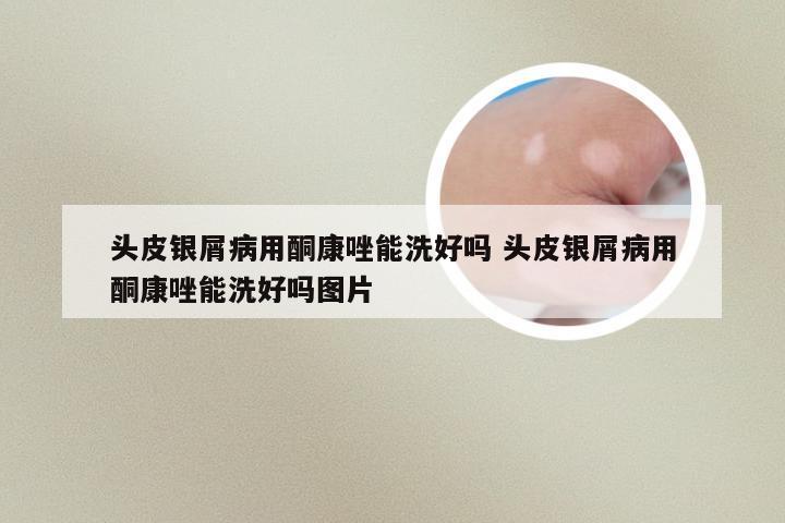 头皮银屑病用酮康唑能洗好吗 头皮银屑病用酮康唑能洗好吗图片