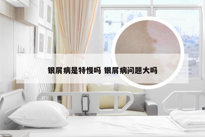 银屑病是特慢吗 银屑病问题大吗